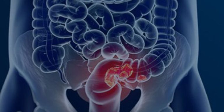 SUS adota novo exame para rastrear câncer colorretal na população sus-adota-novo-exame-para-rastrear-cancer-colorretal-na-populacao
